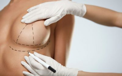 Ventajas de la Reducción Mamaria y/o Mamoplastia Reductora