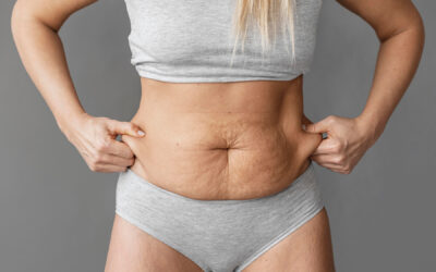 Abdominoplastia preguntas frecuentes de nuestros pacientes