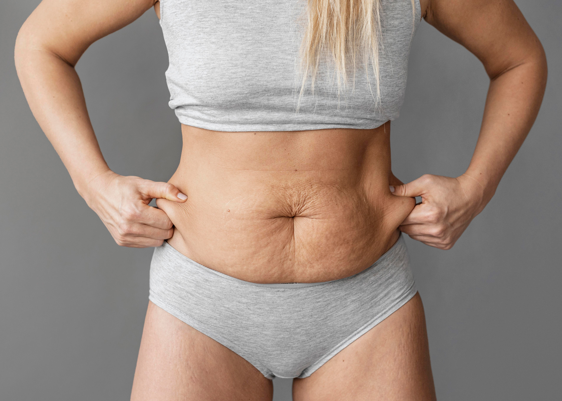 imagen antes abdominoplastia mommy makeover body lift dr jorge rios barranquilla santa marta y cartagena colombia